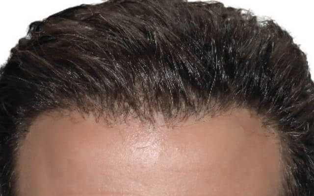 10 months post ai assisted fue-2
